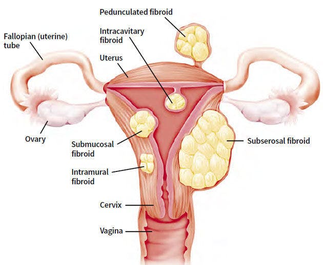 Anatomie de l'utérus avec fibromes